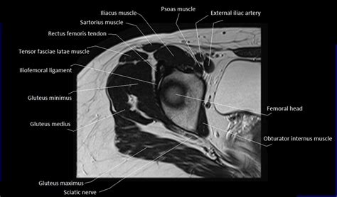 MRI anatomy of hip joint | free MRI axial hip anatomy