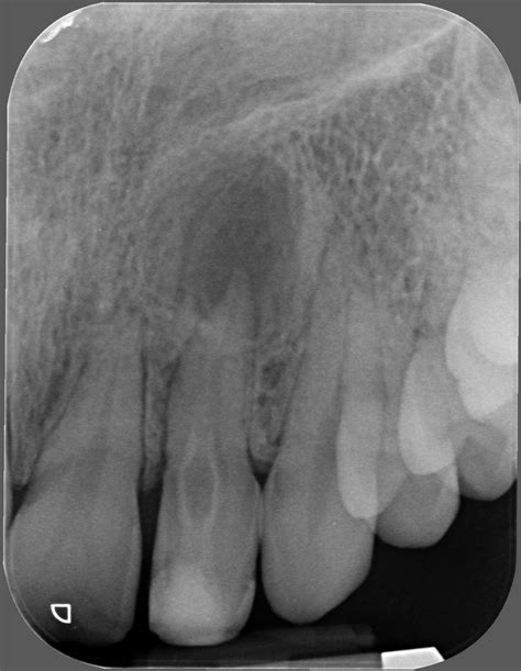 Endodontic Treatment Of Two Maxillary Incisors With Dens Invaginatus