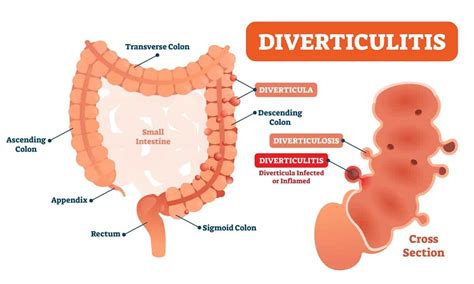 Diverticulitis Disease And Diet Cary Gastroenterology Associates