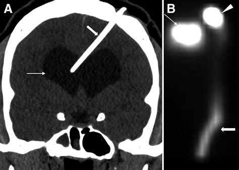 Scintigraphic Detection Of Abdominal Pseudocyst A Complication Of Ventriculoperitoneal Shunt