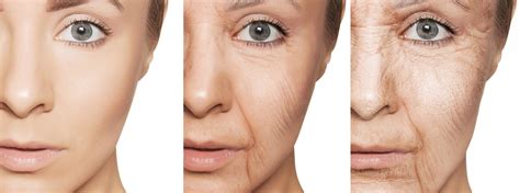 Surrey Wrinkle Treatments Vancouver Wrinkle Procedures Skin Care Clinic