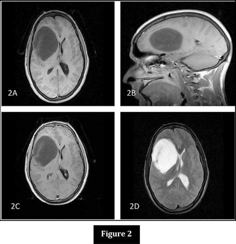 Figure 2 From A Rare Case Of Large Solitary Cerebral Hydatid Cyst