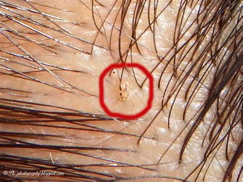 Head Lice Pictures Nature Cultural And Travel