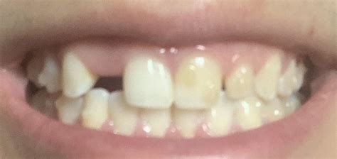 Teeth Turning Yellow Because Of Attachments Why Is One Side Of My