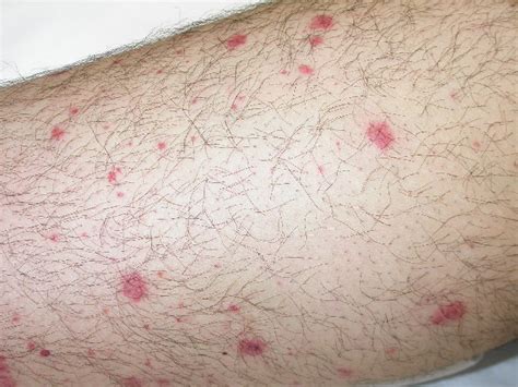 Petechiae Pictures Causes Diagnosis Treatment And Cure