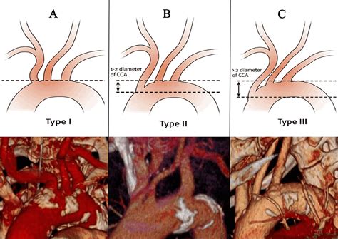 The Relation Between Aortic Arch Branching Types And The Laterality Of