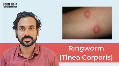Ringworm Tinea Corporis Causes Risk Factors Signs And Symptoms