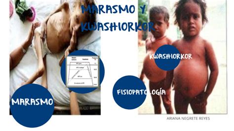 Marasmo Y Kwashiorkor By Oswaldo Aguirre
