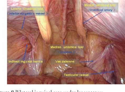 Anatomy Essentials For Laparoscopic Inguinal Hernia Repair Semantic