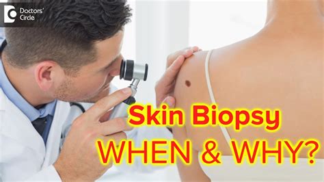 Skin Biopsy Why Is It Done Complications And Hospitalisation Dr Rajdeep Mysoredoctors