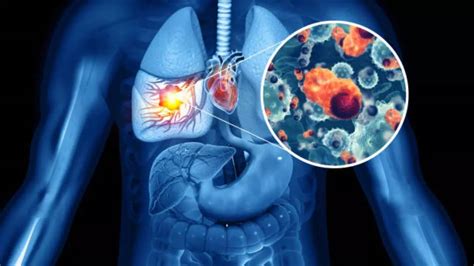 World Lung Cancer Day 2023 Check Here The Early Signs Of The Deadly