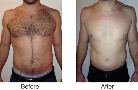 Lightsheer laser hair removal session performed at lege artis skin care inc, toronto, canada. Best quotes for you: To Shave or Not: The Basics of Chest ...
