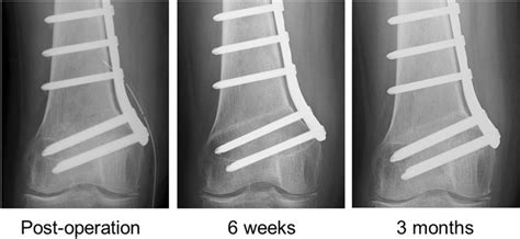 Rapid Bone Healing Case In Medial Closing Wedge Distal Femoral