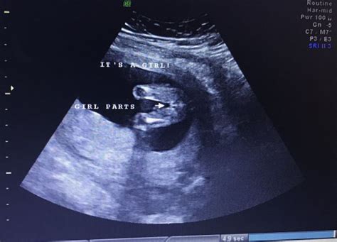 16 Week Ultrasound Need Opinions Babycenter
