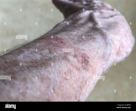 Age Spots On The Forearm Of A 72 Year Old Woman Stock Photo Alamy