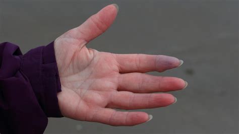 What It Really Means When Your Fingers Turn Purple