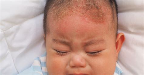Jangan lupa remas dan pijat kulit kepala dan juga rambut agar meresap. Inilah 7 Cara Hilangkan Kerak Kepala Bayi Dengan Berkesan ...