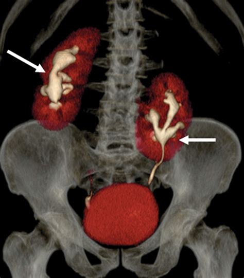 Congenital Anomalies Of The Upper Urinary Tract A Comprehensive Review Radiographics