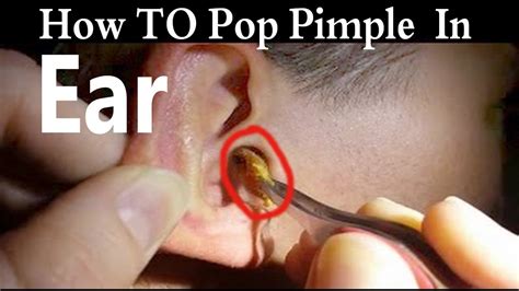 how to pop pimple in ear ear pimple youtube