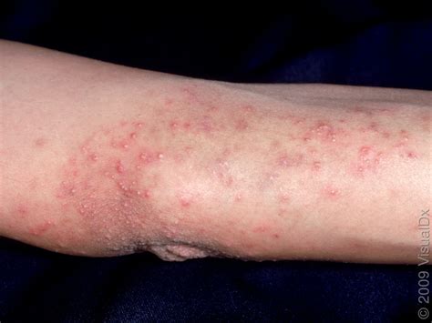 Maybe you would like to learn more about one of these? Dermatitis Herpetiformis (Duhring's disease), Salt Lake ...