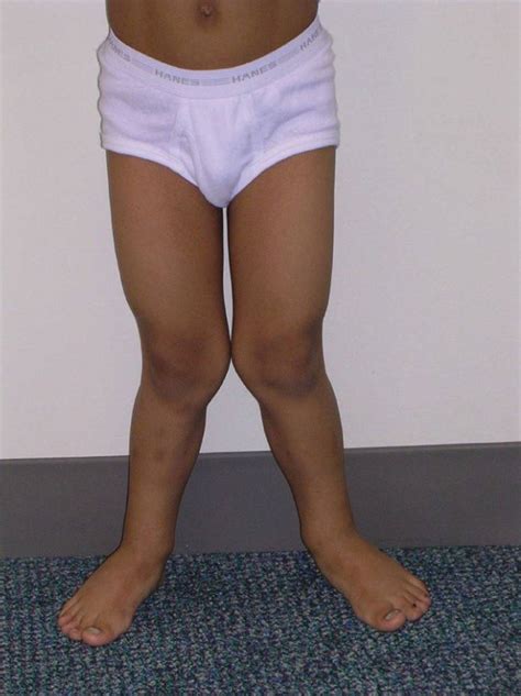 Leg Bowing And Knock Knees Visual Diagnosis And Treatment In