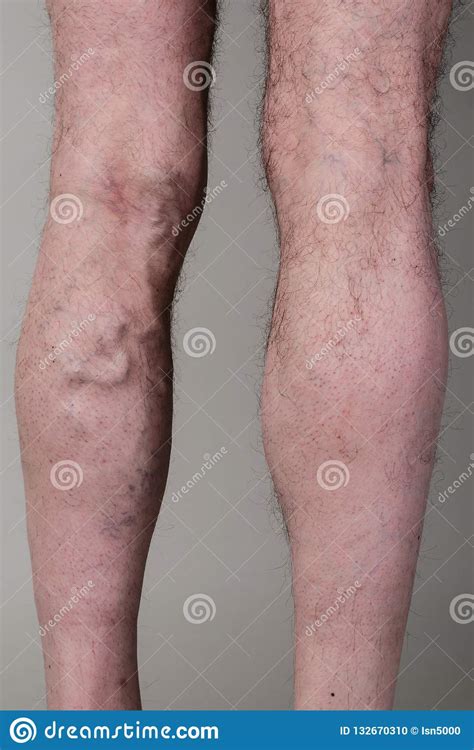 Varicose Vein Treatment Stock Images Download 568
