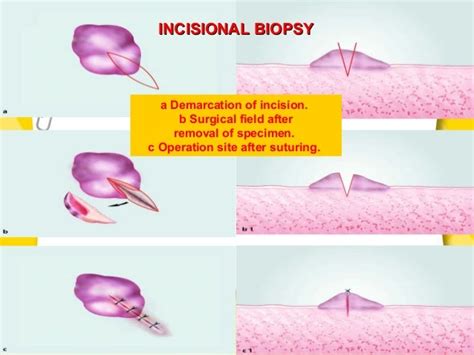 Biopsy