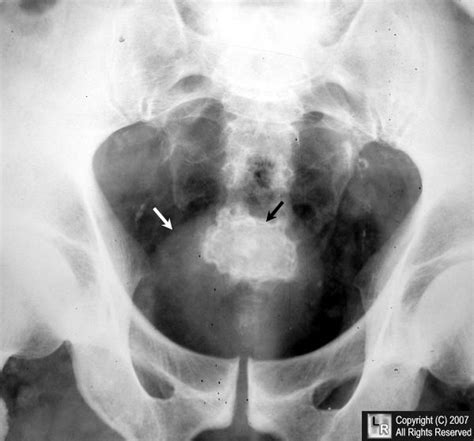 Jackstone Calculus In Urinary Bladder There Is A Laminated