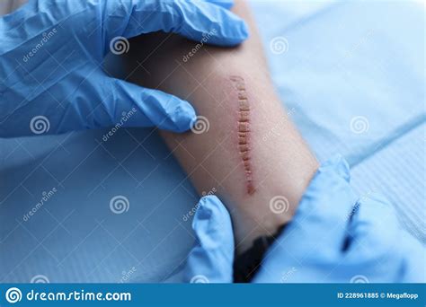 Wound Infection On The Skin A Wound On The Human Body Suture Old
