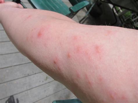 What Does Poison Ivy Rash Look Like Pictures Photos Of Poison Ivy