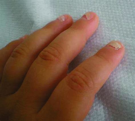 Onycomadesis In A Small Child Proximal Separation Of The Nail Plate