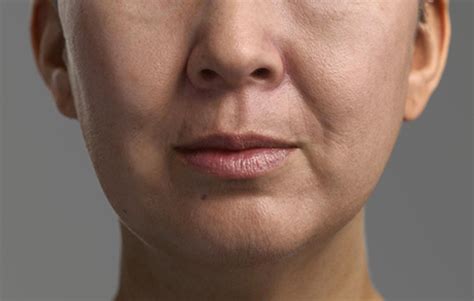 Restore Aging Face Or Sunken Cheeks With Collagen Treatment Gjk