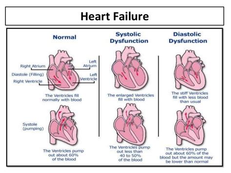 Acute Left Ventricular Failure Secondary To Ischemic Heart Disease A