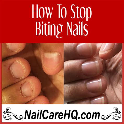 How To Stop Biting Nails Angelas Results Nail Care Hq