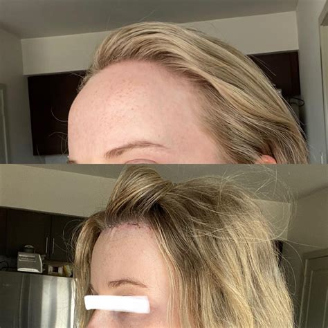 Before And After Hairline Lowering 3cm 8 Days Post Op Rplasticsurgery