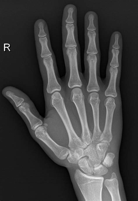 Hamate Fracture Image