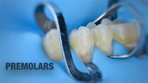 The Secret Recipe To Isolate Class 5 Caries For Lower Premolars Youtube