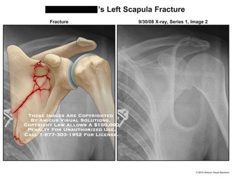 Amicus Illustration Of Amicus Injury Radiology Scapula Fracture X Ray