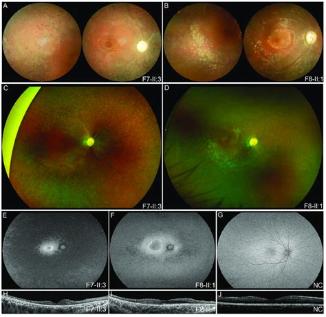 Multimodal Fundal Images Of Two Probands With Eosrd Complete Optic