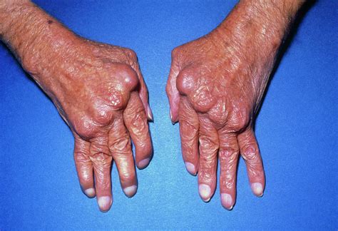 Hands With Rheumatoid Arthritis Photograph By James Stevensonscience