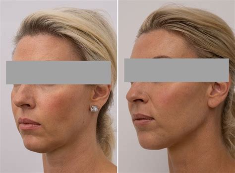 Jowl Treatment Melbourne Treatment Areas Face To Face Medical