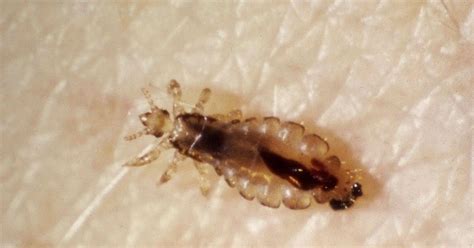 Head Lice Facts Health And Beauty Insect Species