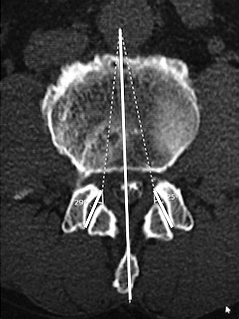 Synovial Facet Joint Cysts After Lumbar Posterior Decompression Surgery