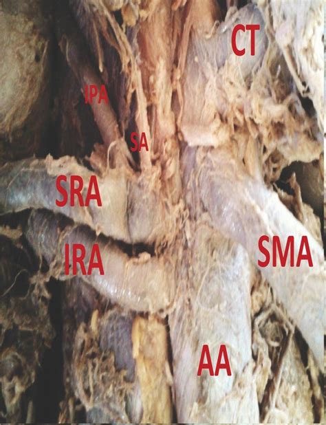Origin Of The Right Inferior Phrenic And Suprarenal Arteries Aa