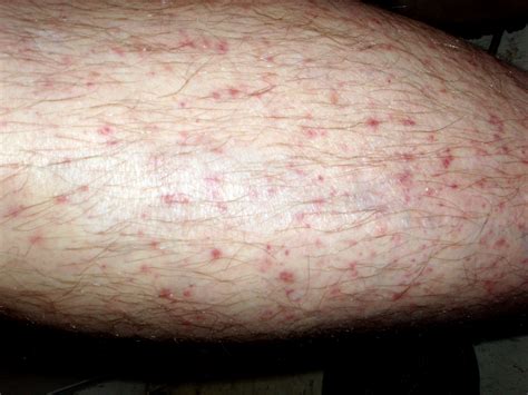Rashes On Lower Legs Pictures Photos