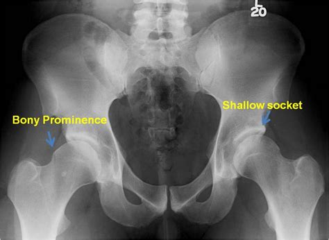 Pao Surgery For Hip Dysplasia In An Active 25 Year Old Male John C