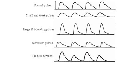 Four Classes Of Waveform Based On Dicrotic Notch This Classification