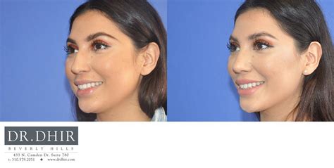Best Rhinoplasty Beverly Hills Natural Results Dr Dhir Plastic Surgery