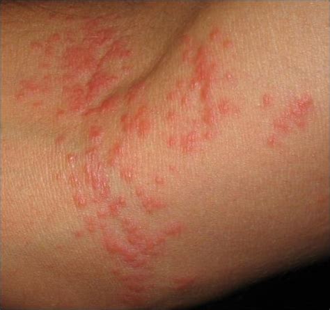 Rash on Body That Itches | Dorothee Padraig South West ...