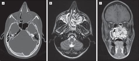 Nasal Obstruction Associated With A Unilateral Maxillary Sinus Mass